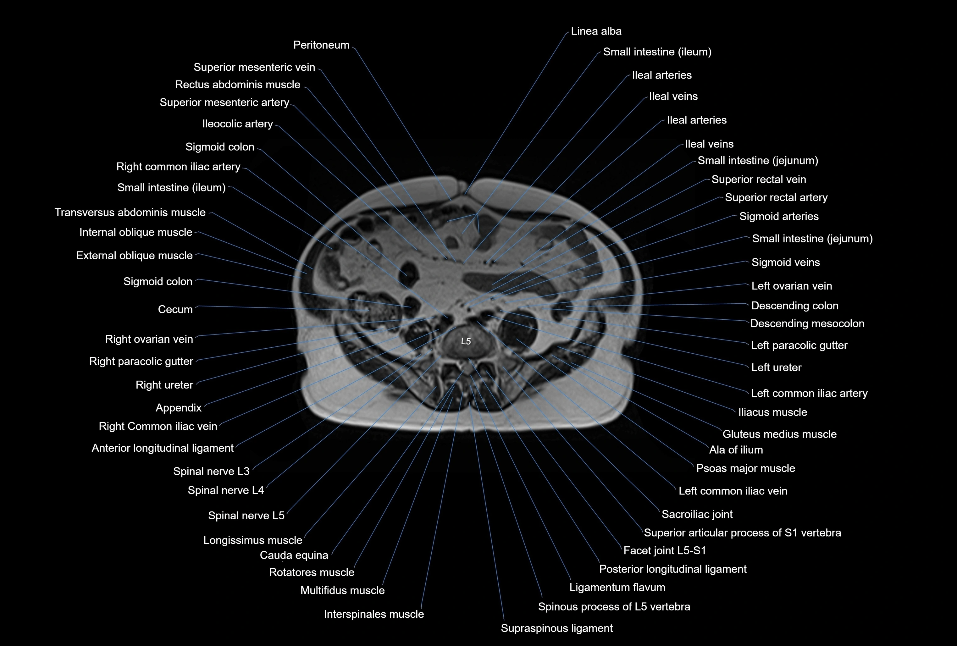 MRI Abdomen axial cross sectional anatomy radiology  image-img-00001-00037.webp
